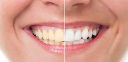 Aplicativo para clarear os dentes – Veja como ficar com dentes de celebridade