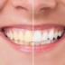 Aplicația de albire a dinților – Vezi cum să obții dinți de celebrități