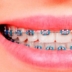 Diş teli simülatörü uygulaması – Nasıl görüneceğinizi görün