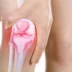 改善膝关节疼痛——改善膝关节疼痛的应用程序